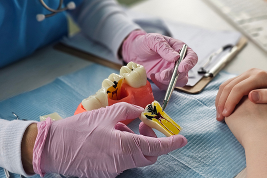 Why Do I Need A Crown After Root Canal Treatment?